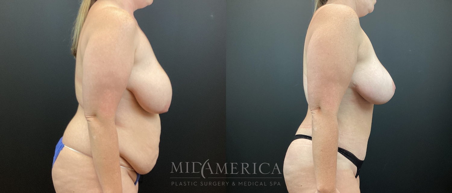 Mommy Makeover Before & After