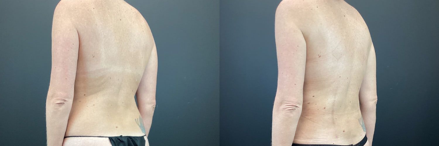 Mommy Makeover Before & After