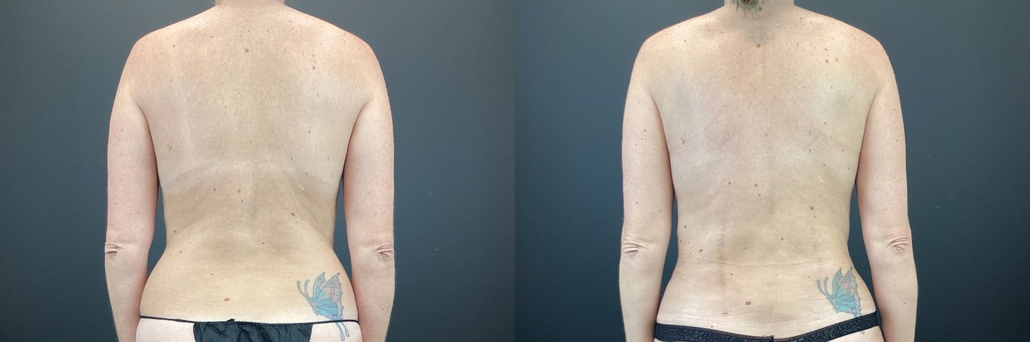 Mommy Makeover Before & After