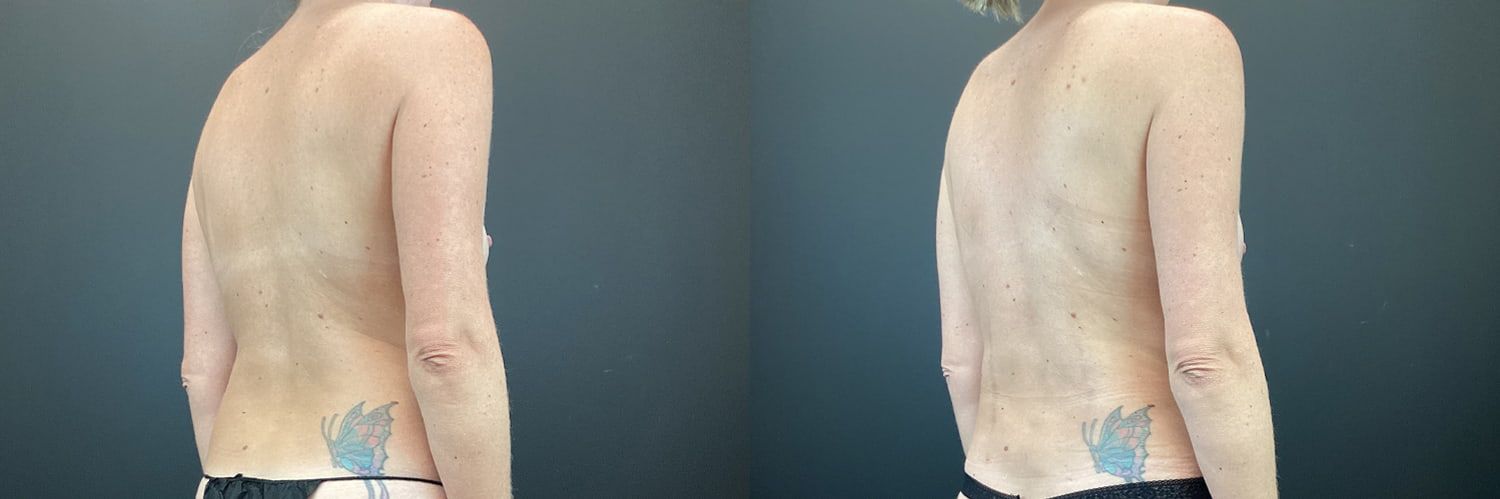 Mommy Makeover Before & After