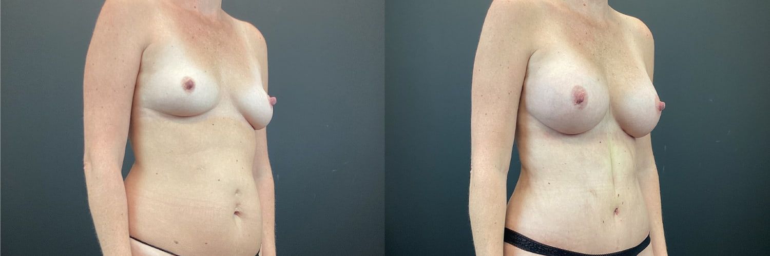 Mommy Makeover Before & After