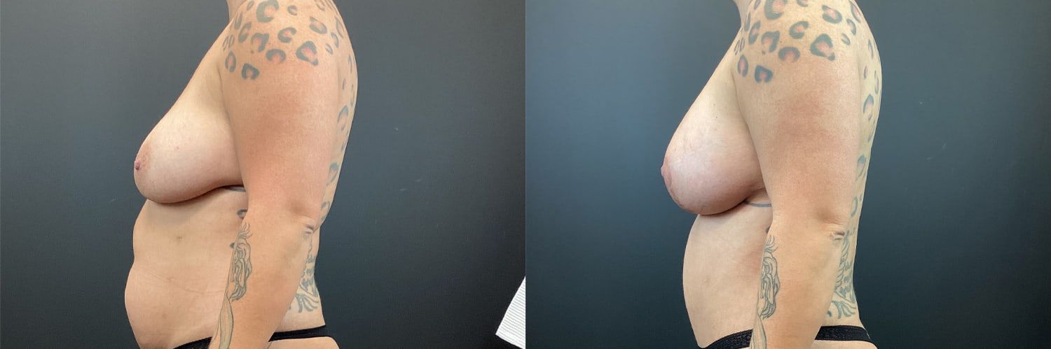 Mommy Makeover Before & After