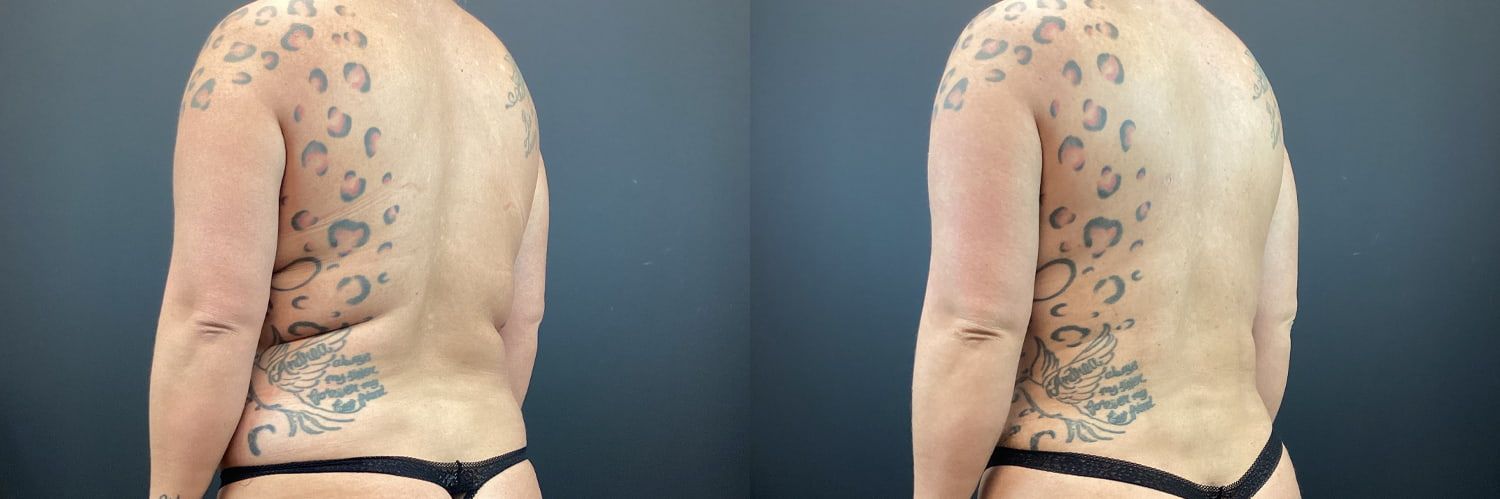 Mommy Makeover Before & After