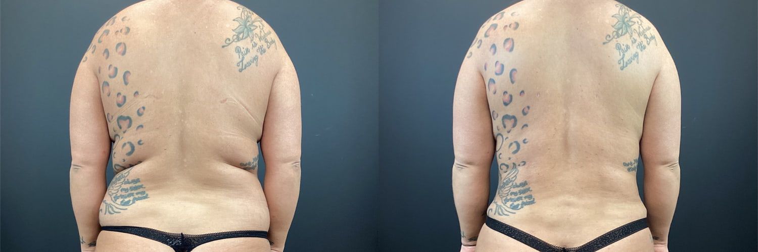 Mommy Makeover Before & After