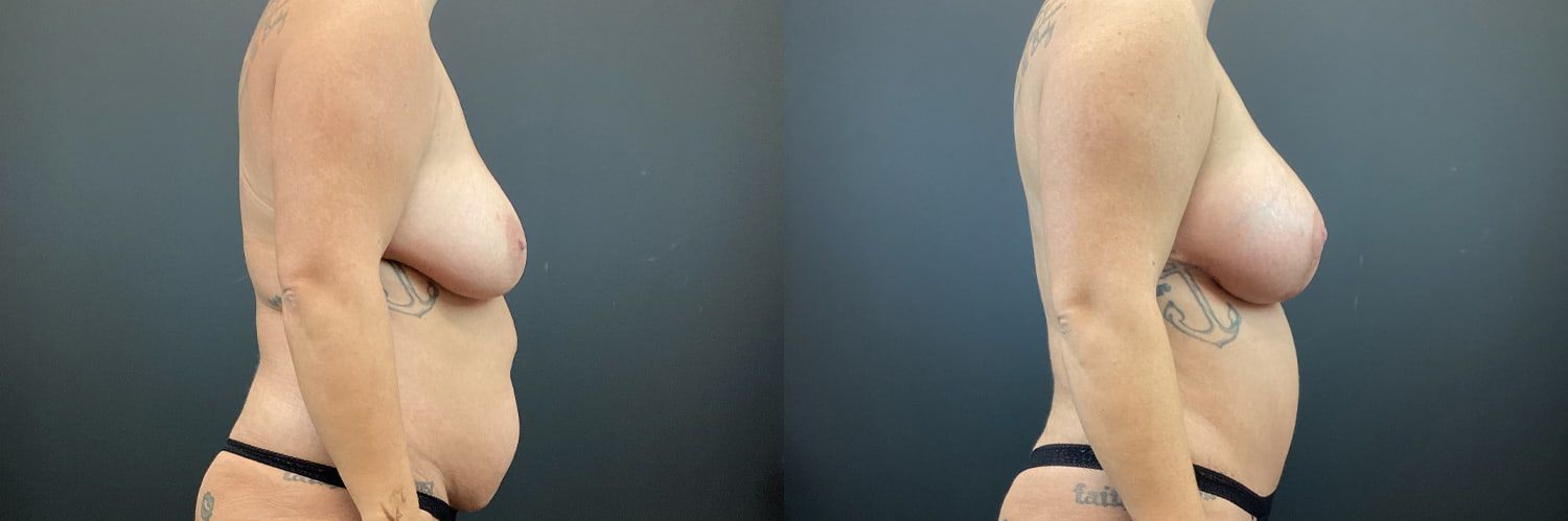 Mommy Makeover Before & After