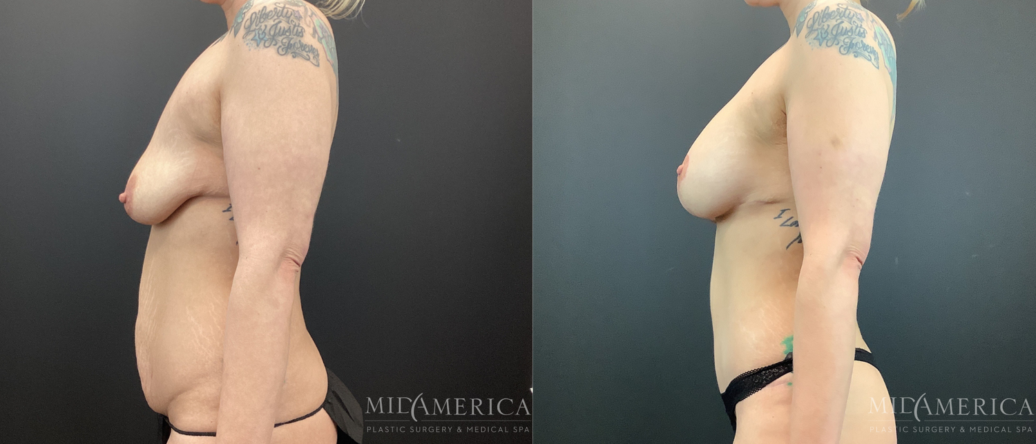 Mommy Makeover Before & After