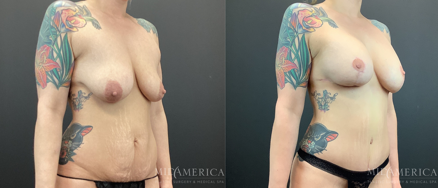 Mommy Makeover Before & After