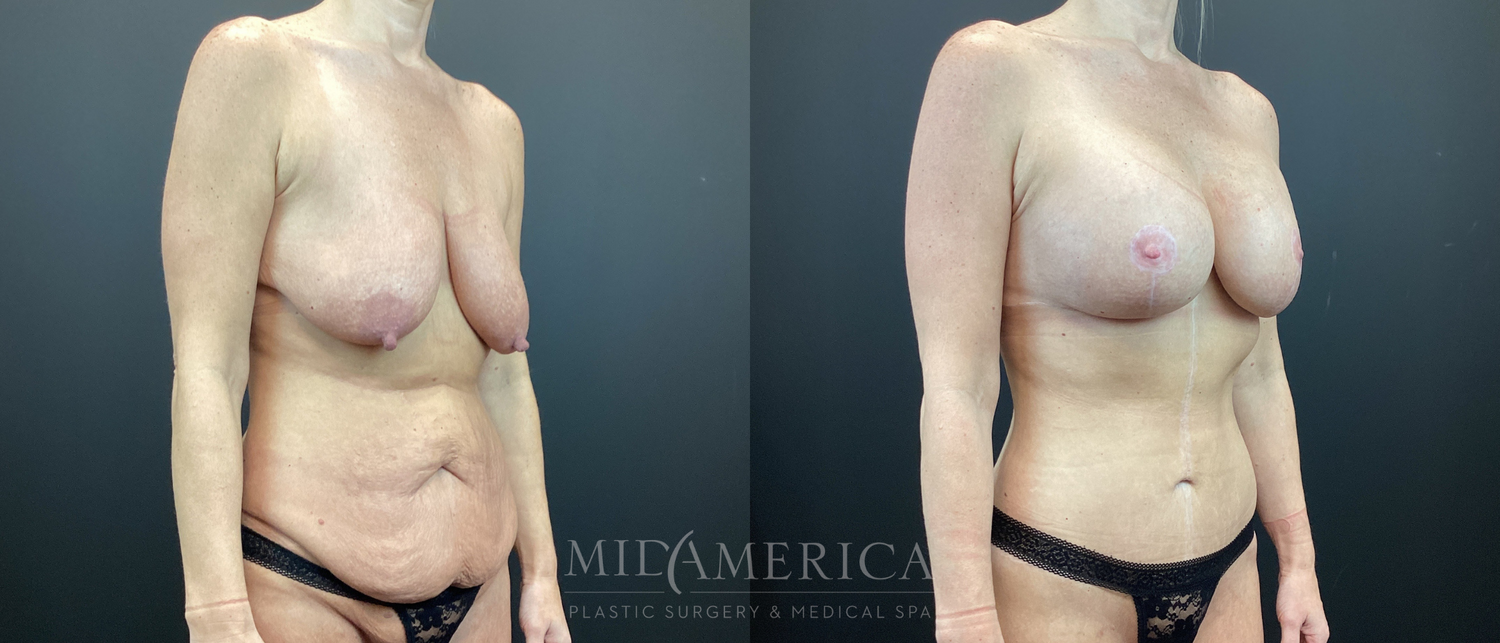 Mommy Makeover Before & After