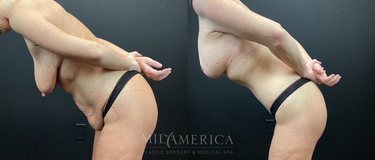 Mommy Makeover Before & After