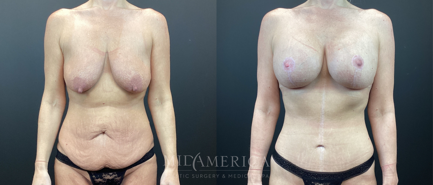 Mommy Makeover Before & After