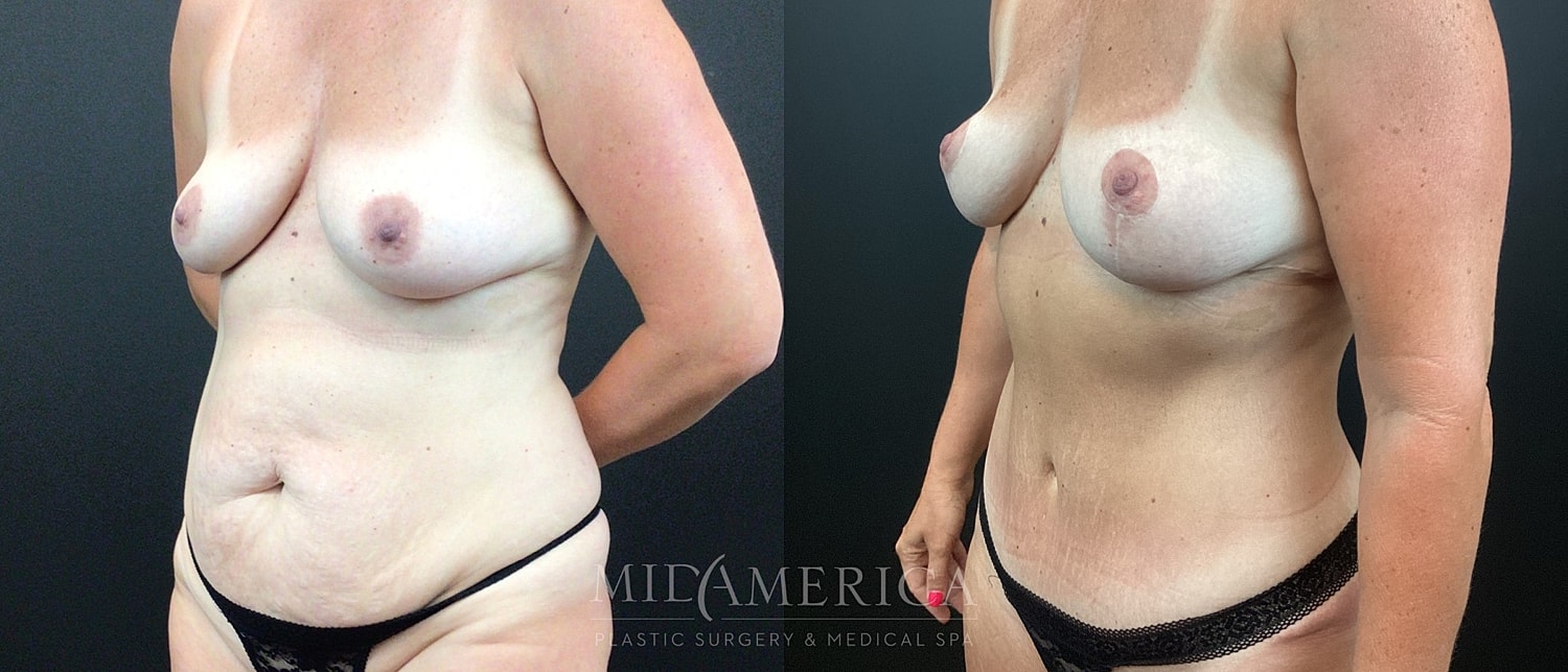 Mommy Makeover Before & After