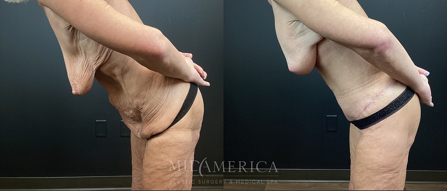 Mommy Makeover Before & After