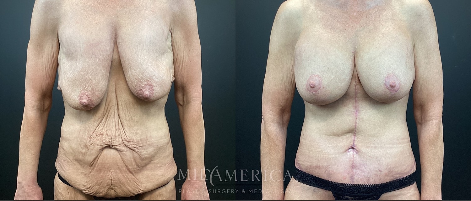 Mommy Makeover Before & After