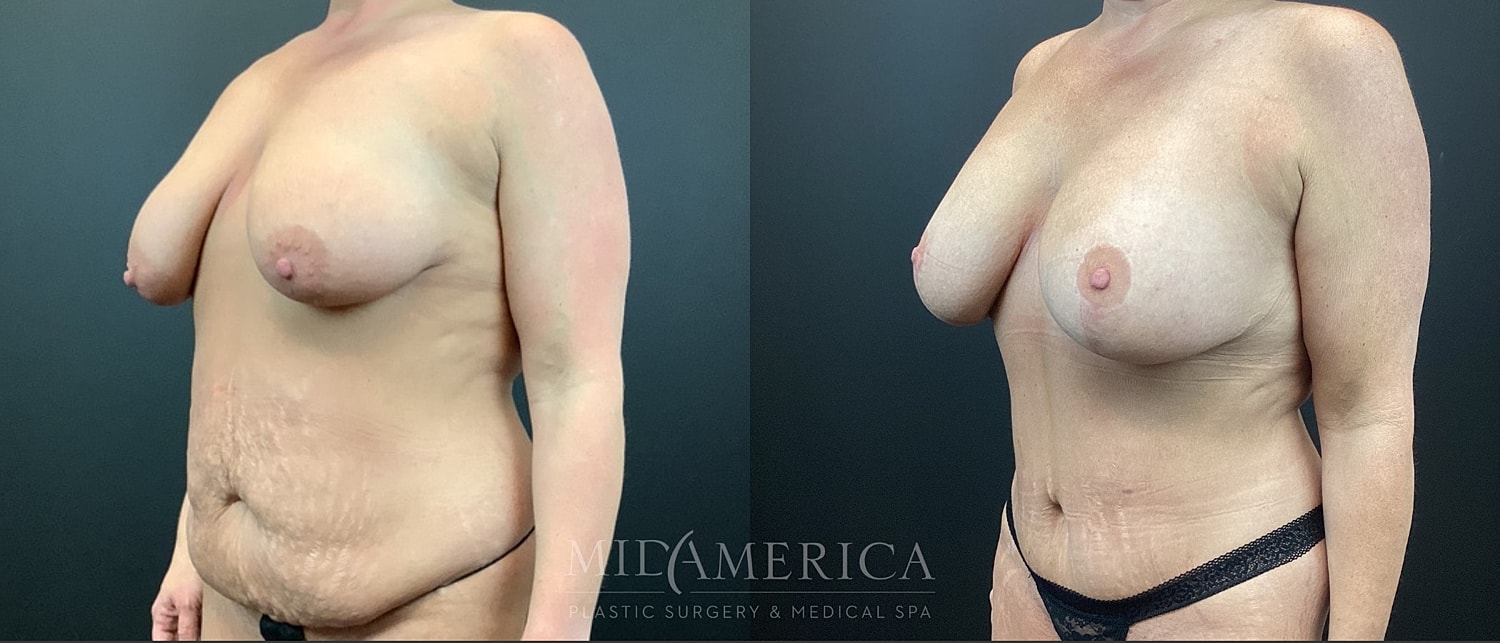 Mommy Makeover Before & After