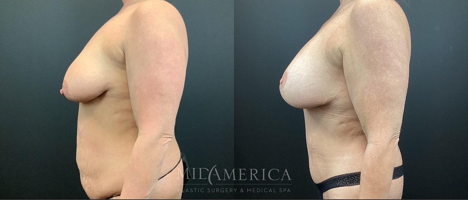 Mommy Makeover Before & After