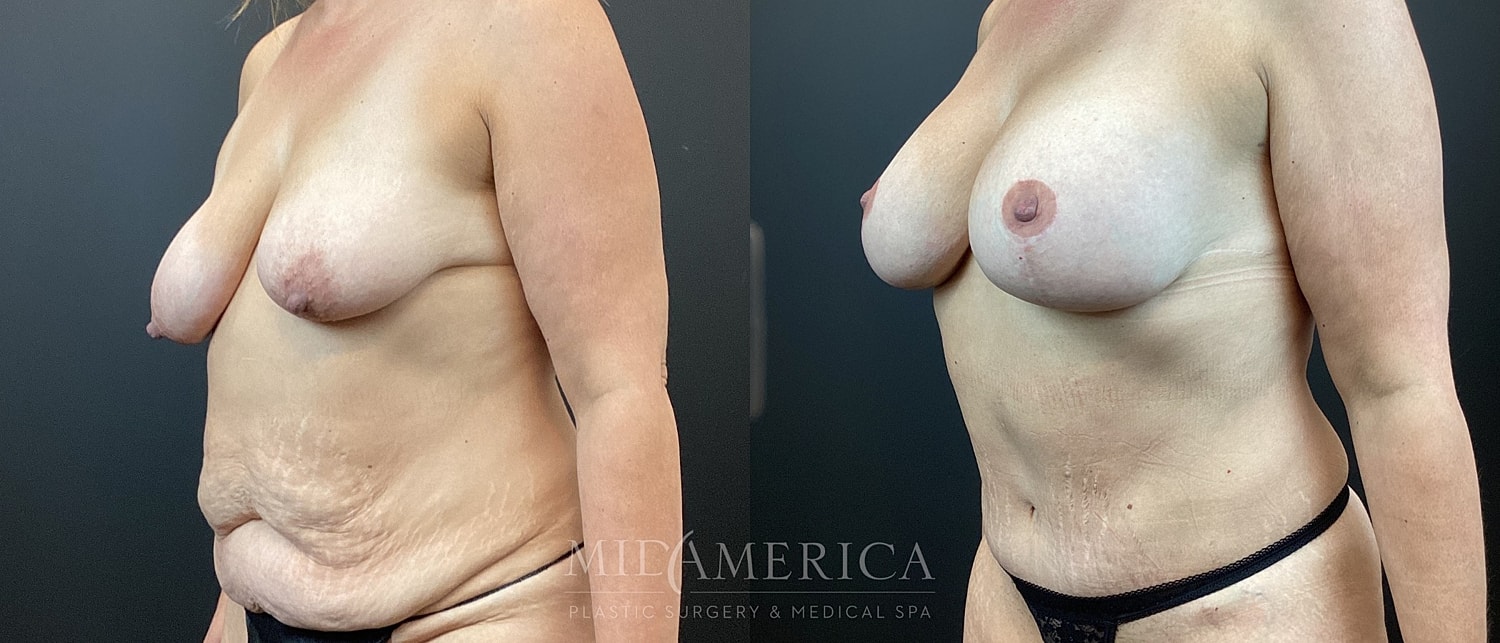 Mommy Makeover Before & After