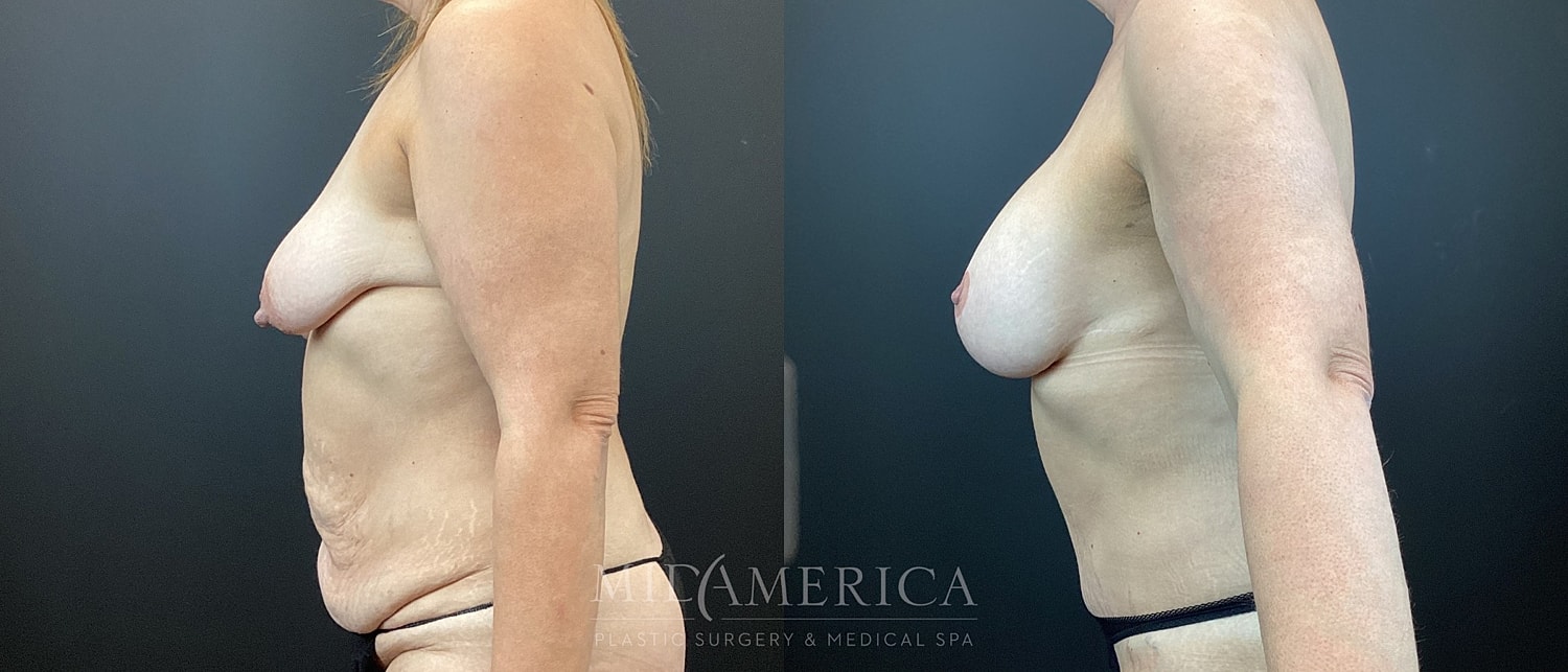 Mommy Makeover Before & After