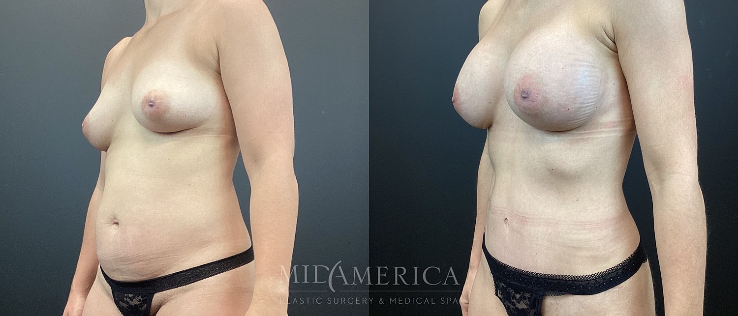 Mommy Makeover Before & After