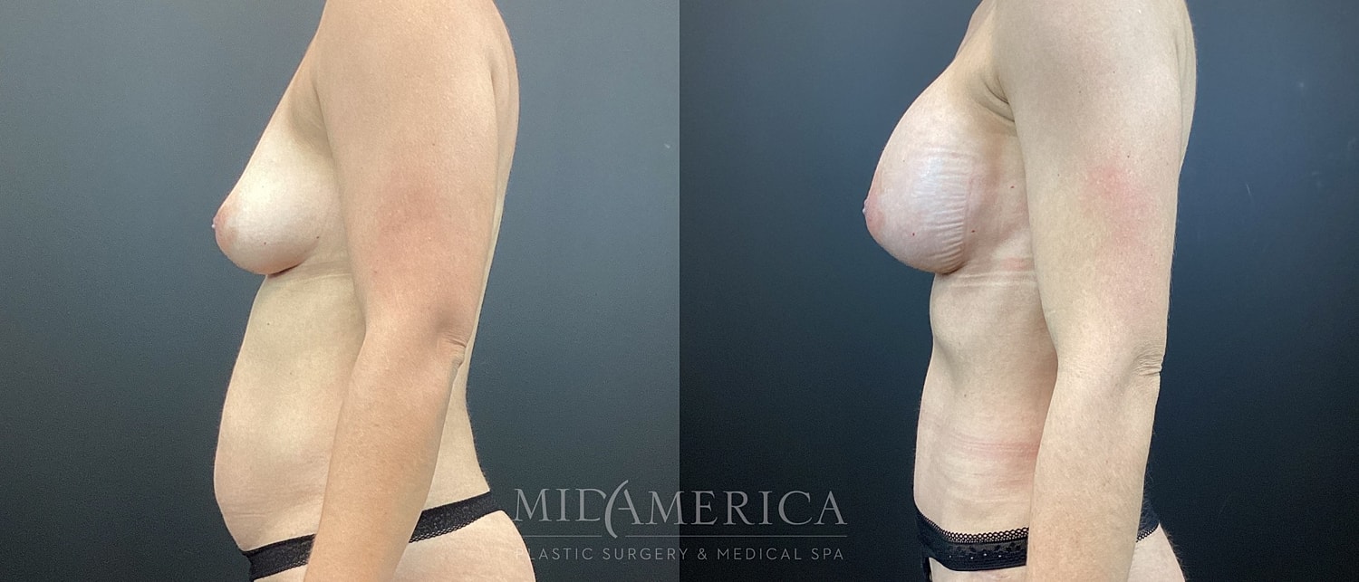 Mommy Makeover Before & After