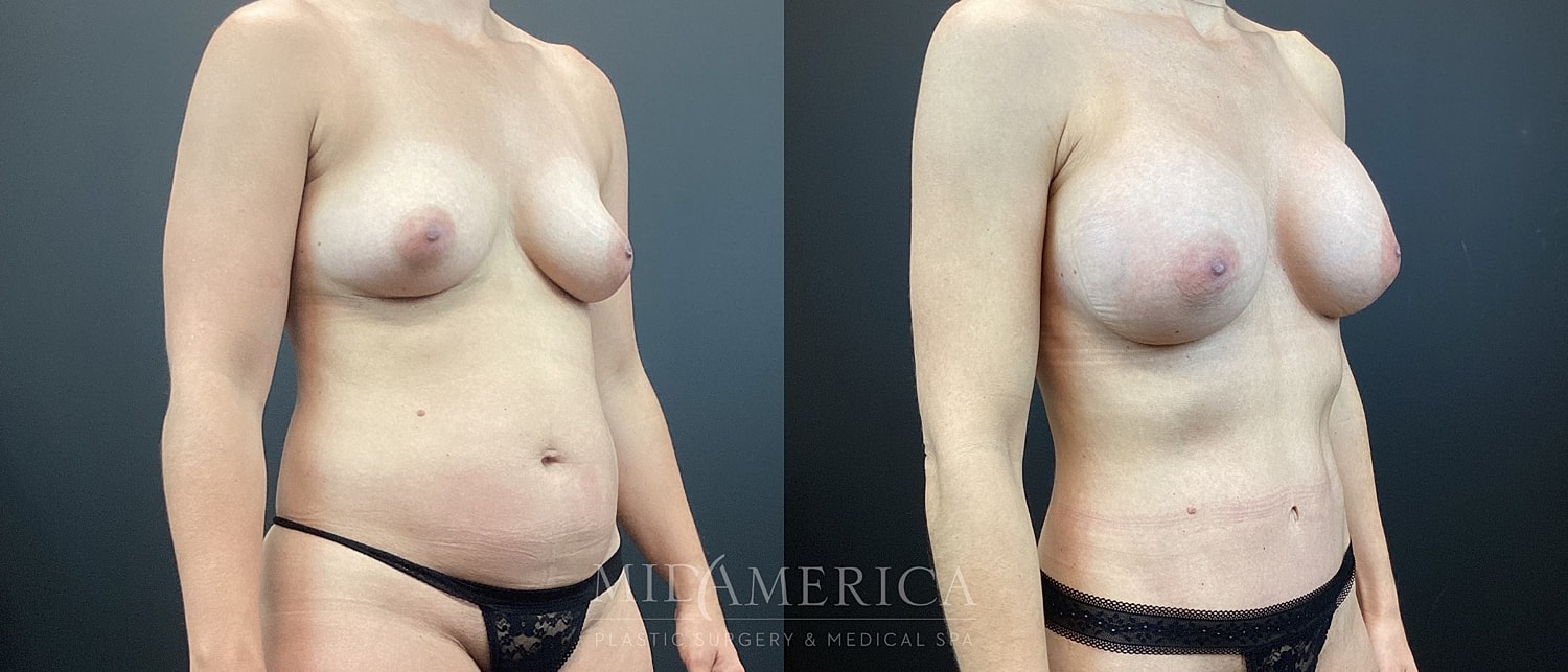 Mommy Makeover Before & After