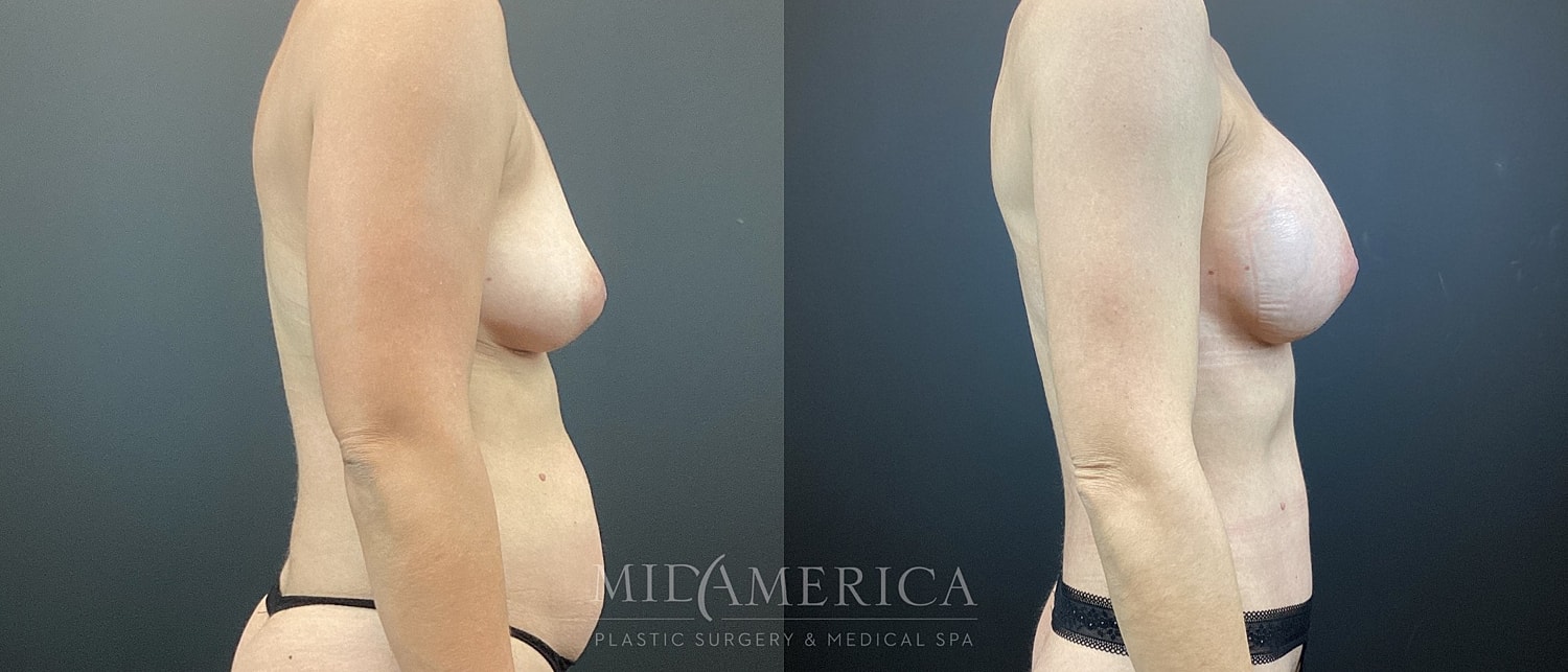 Mommy Makeover Before & After