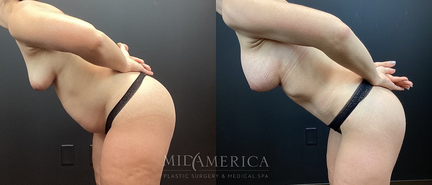 Mommy Makeover Before & After