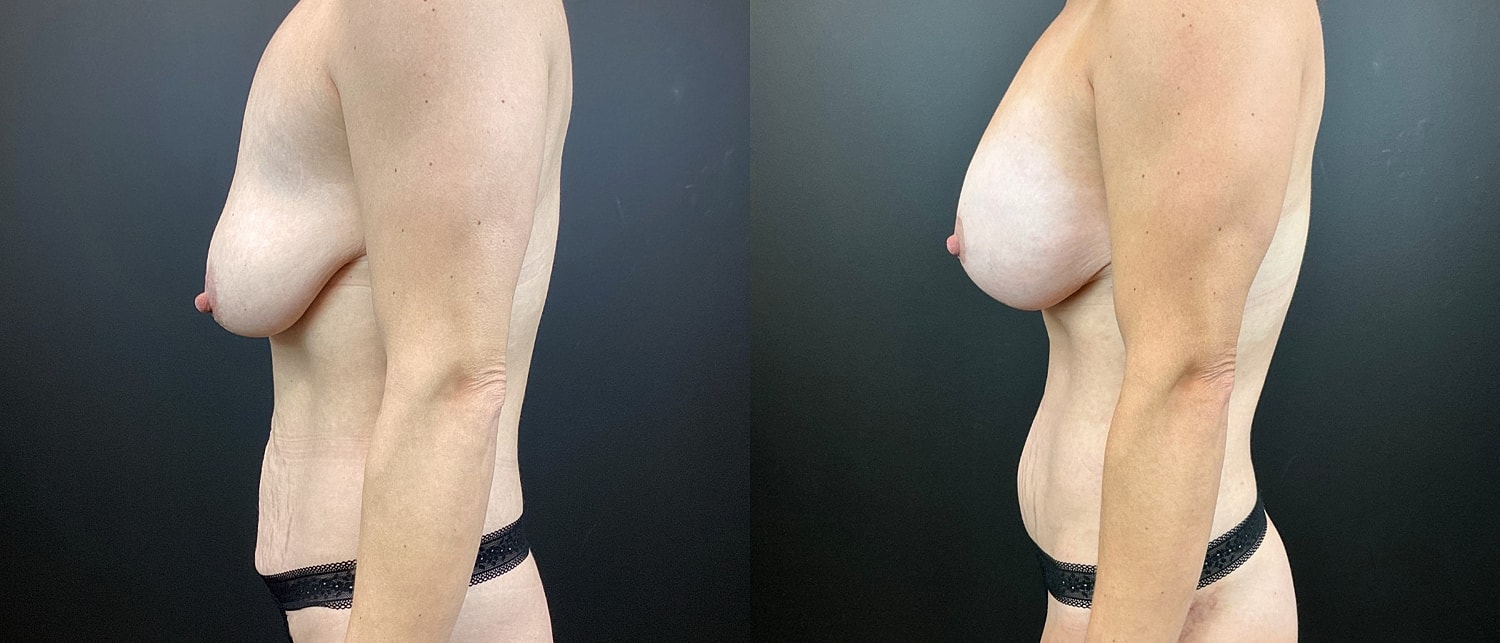 Mommy Makeover Before & After