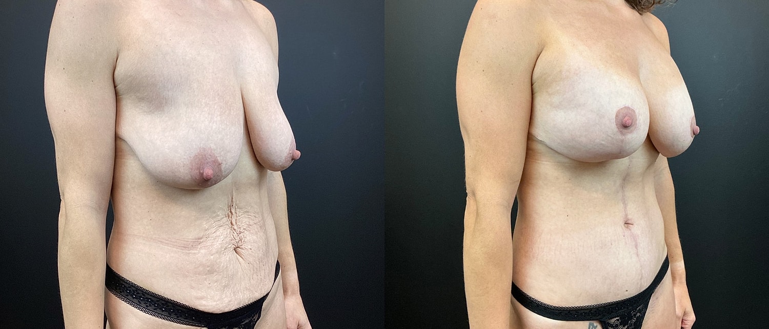 Mommy Makeover Before & After