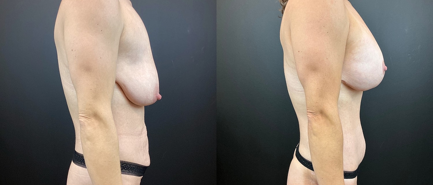 Mommy Makeover Before & After