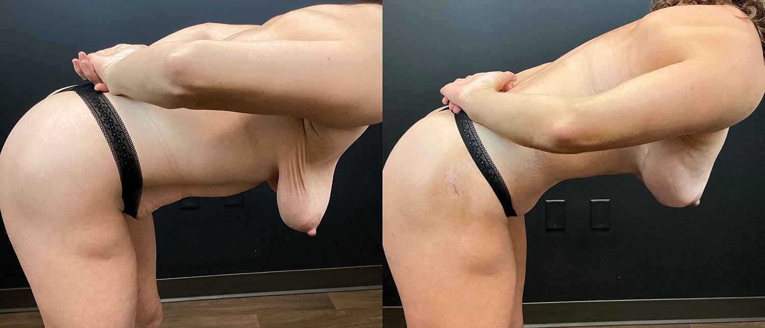 Mommy Makeover Before & After