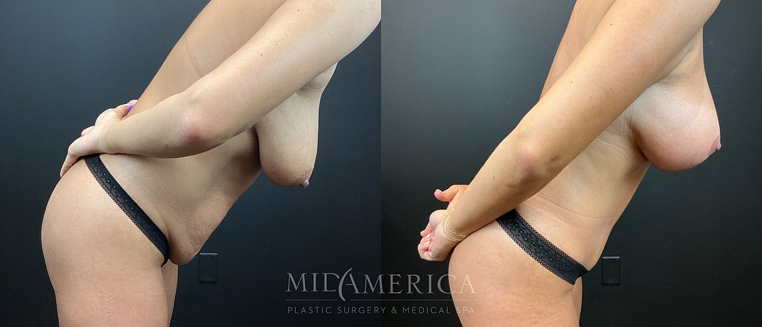 Mommy Makeover Before & After