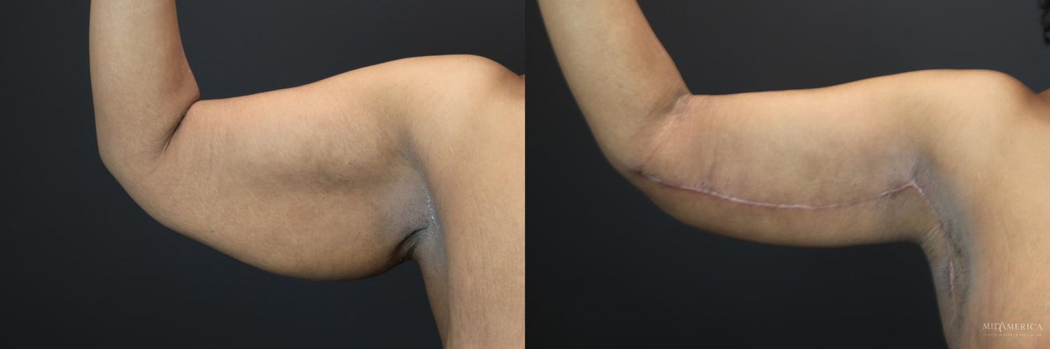 Brachioplasty Before & After