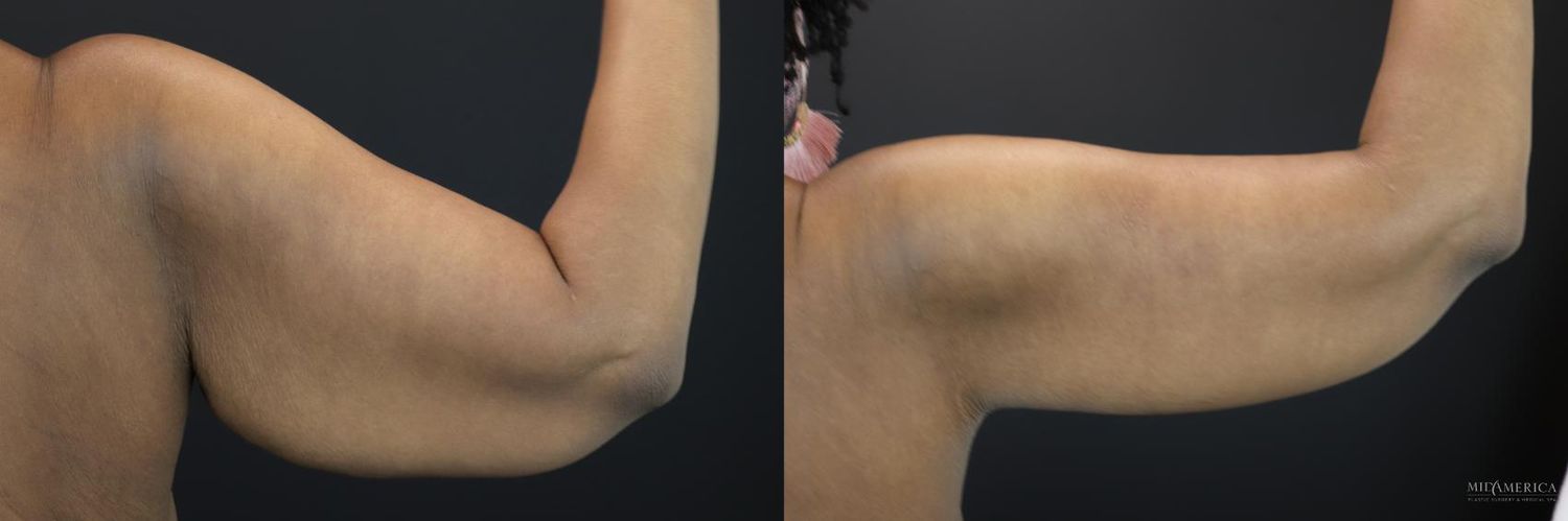Brachioplasty Before & After