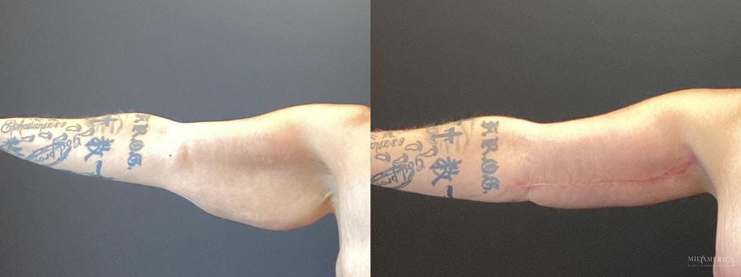 Brachioplasty Before & After