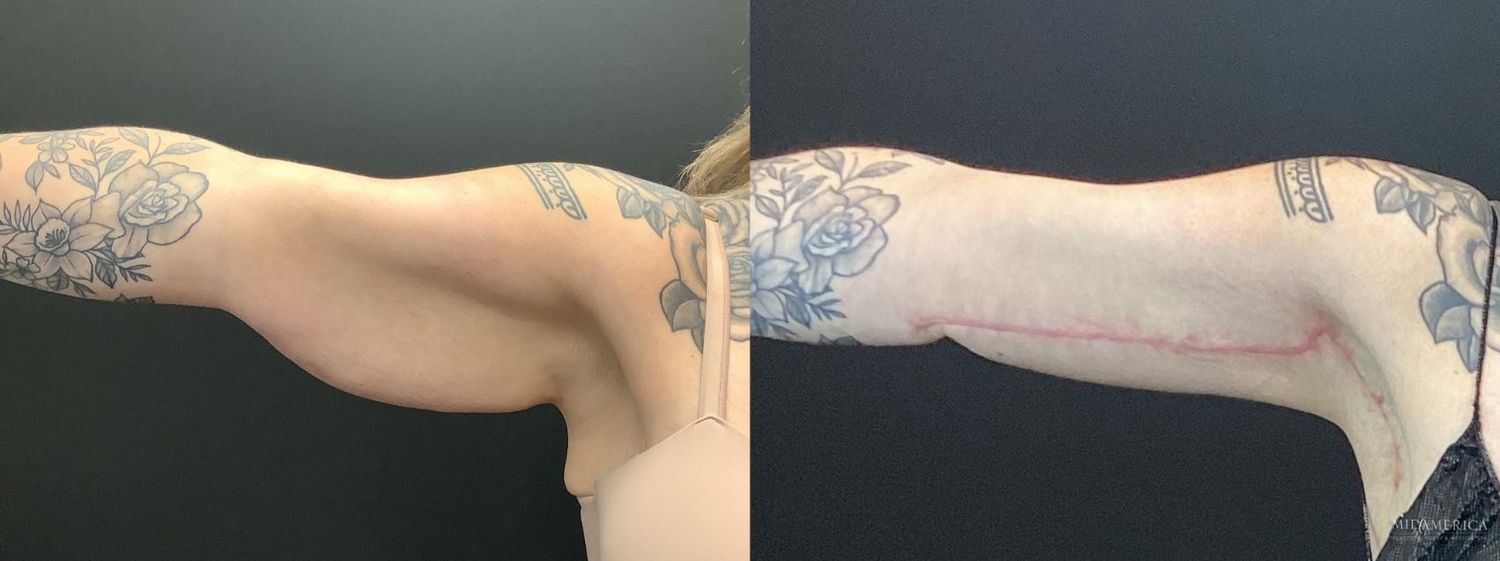 Brachioplasty Before & After