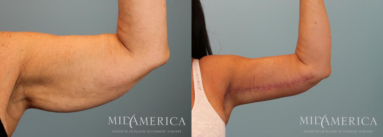 Brachioplasty Before & After