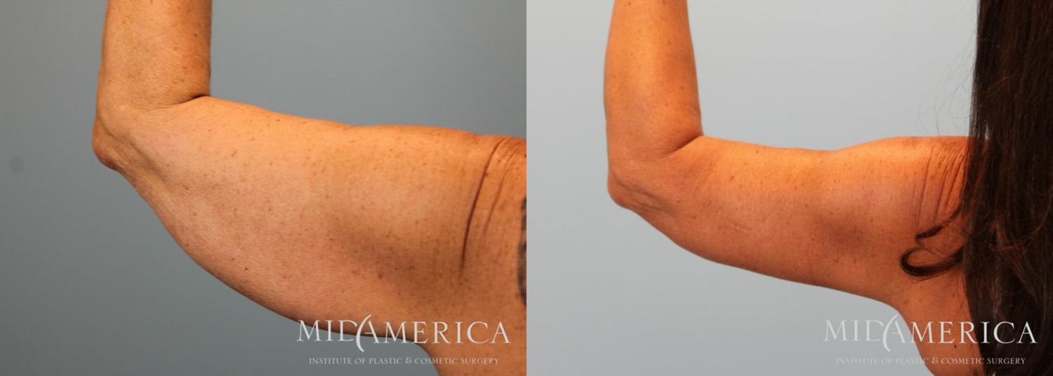 Brachioplasty Before & After
