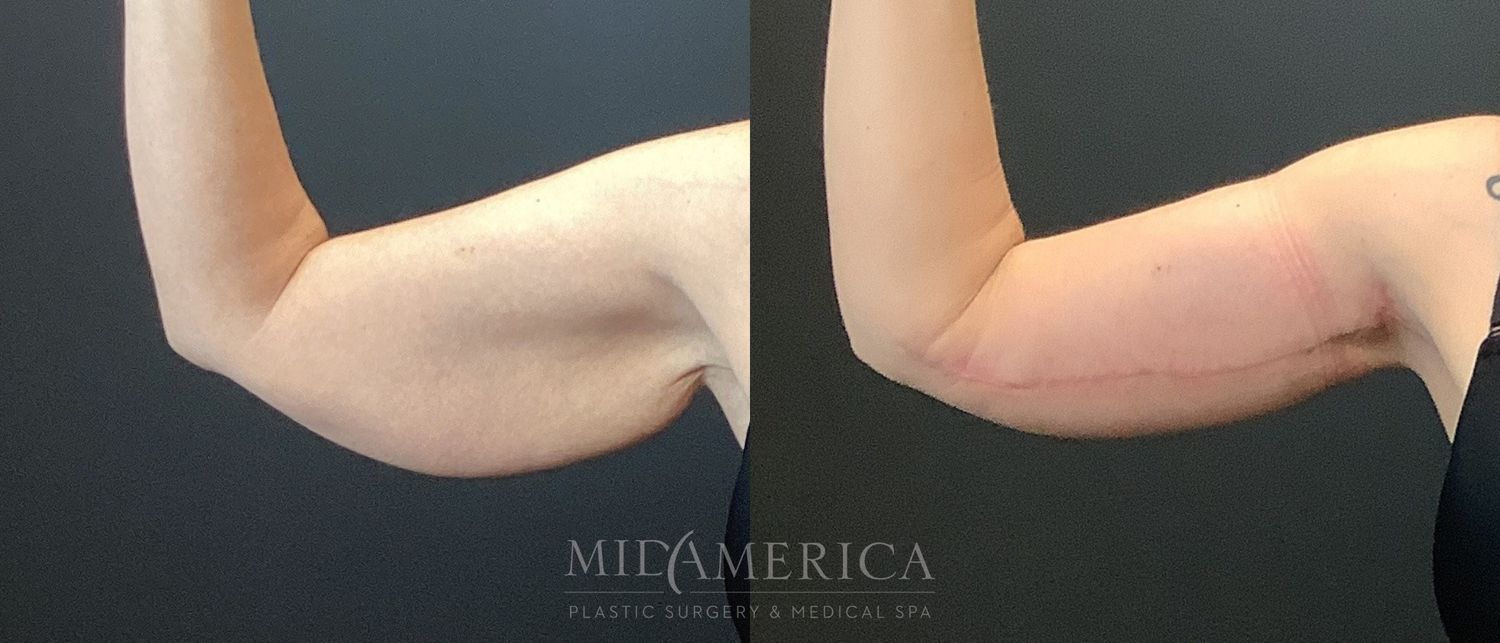 Brachioplasty Before & After