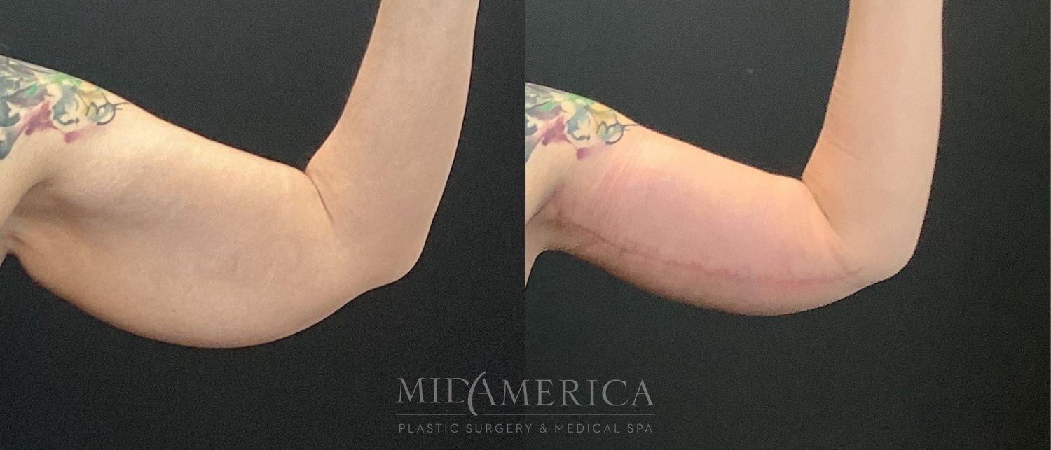 Brachioplasty Before & After