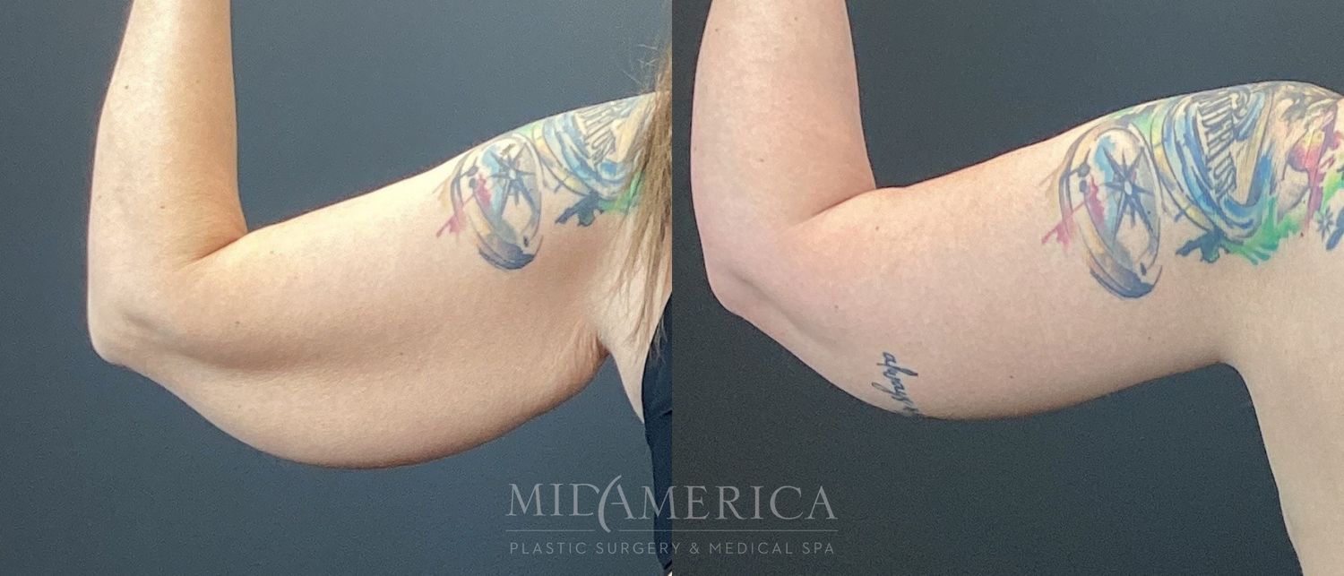 Brachioplasty Before & After