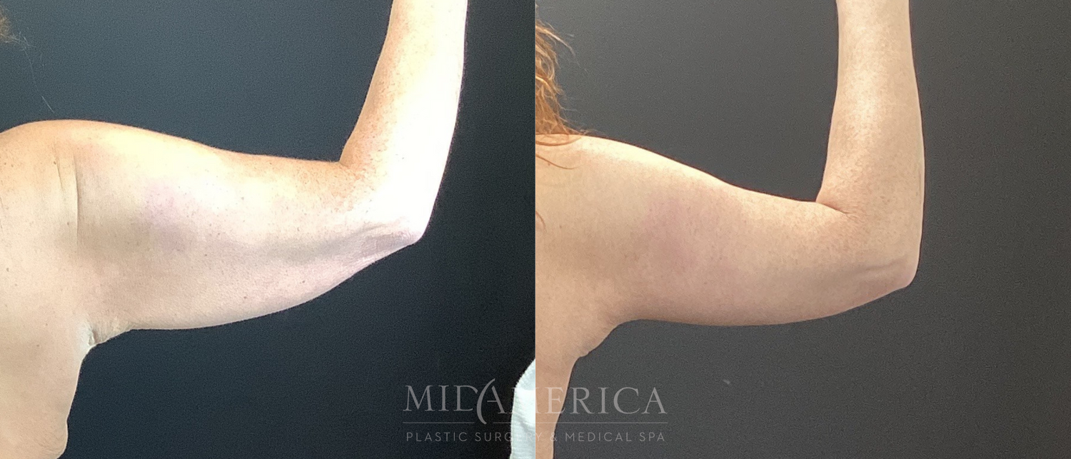 Brachioplasty Before & After