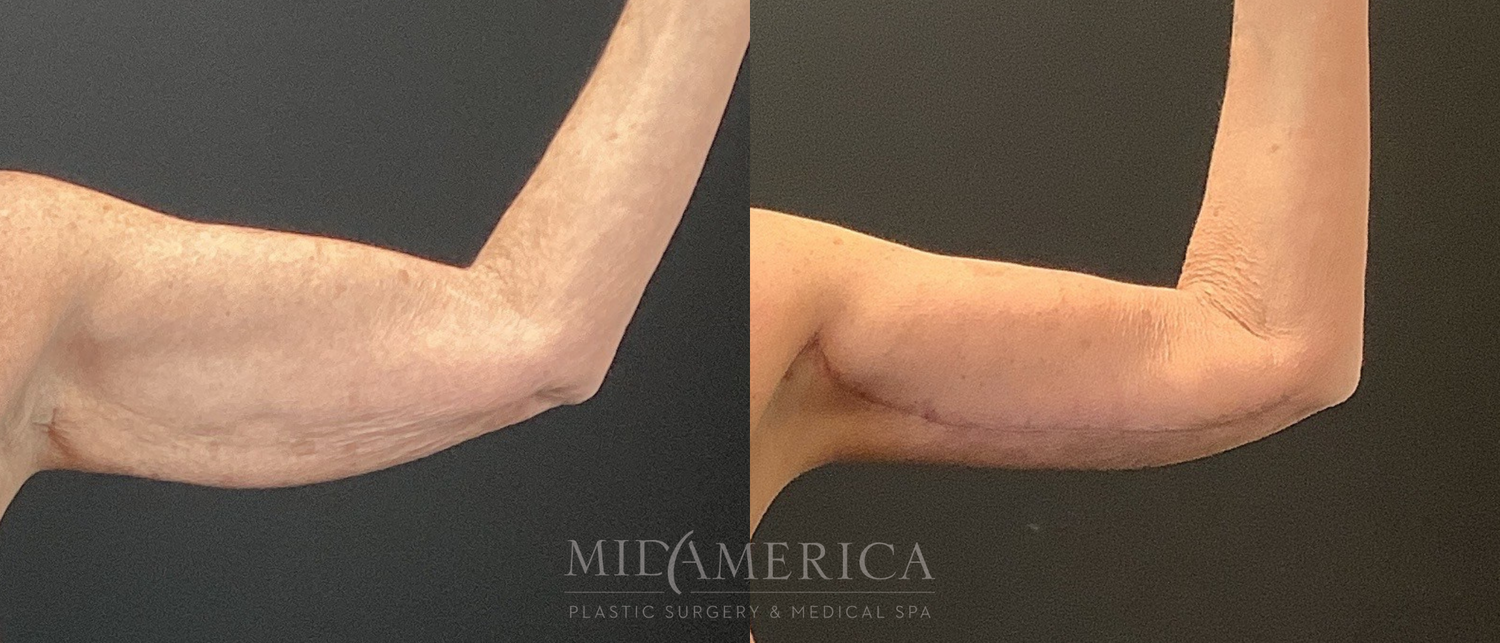 Brachioplasty Before & After