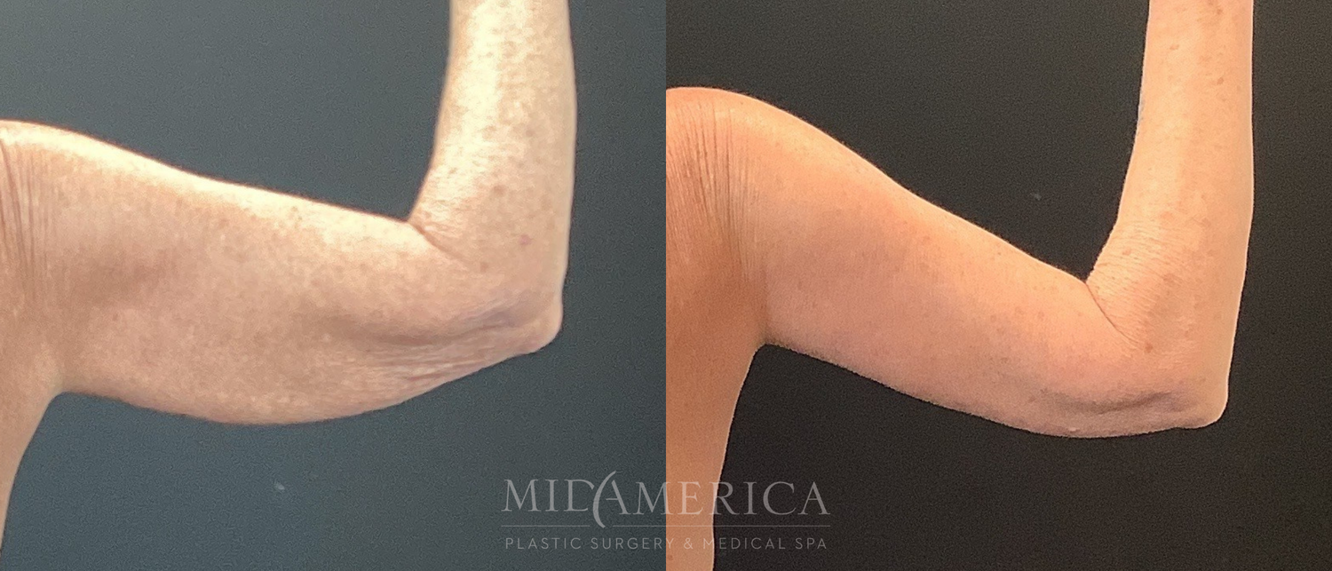 Brachioplasty Before & After