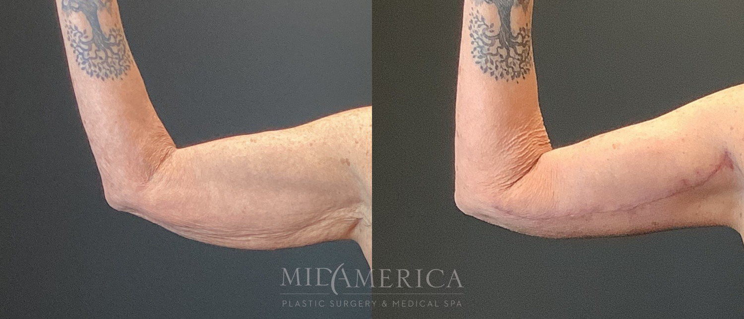 Brachioplasty Before & After