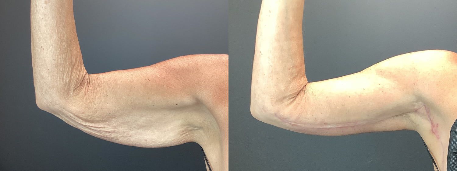 Brachioplasty Before & After