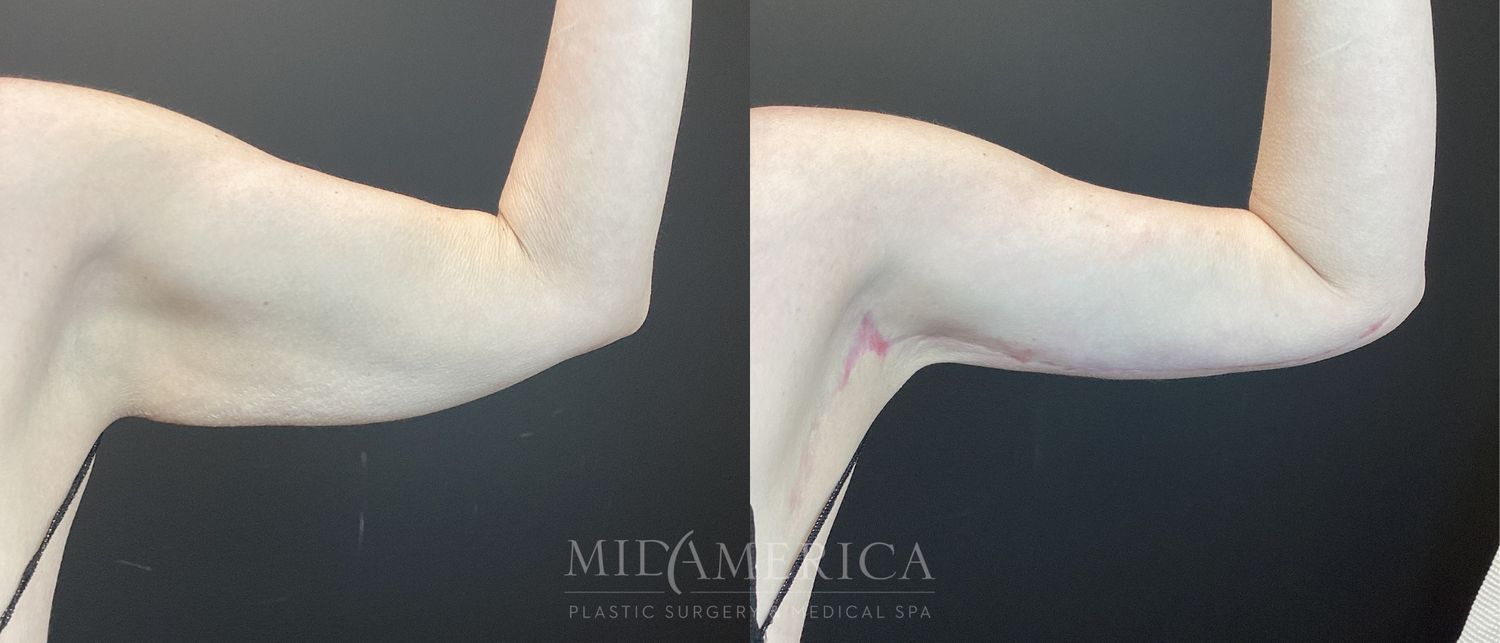 Brachioplasty Before & After