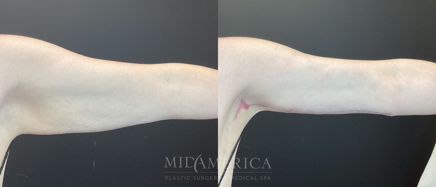 Brachioplasty Before & After