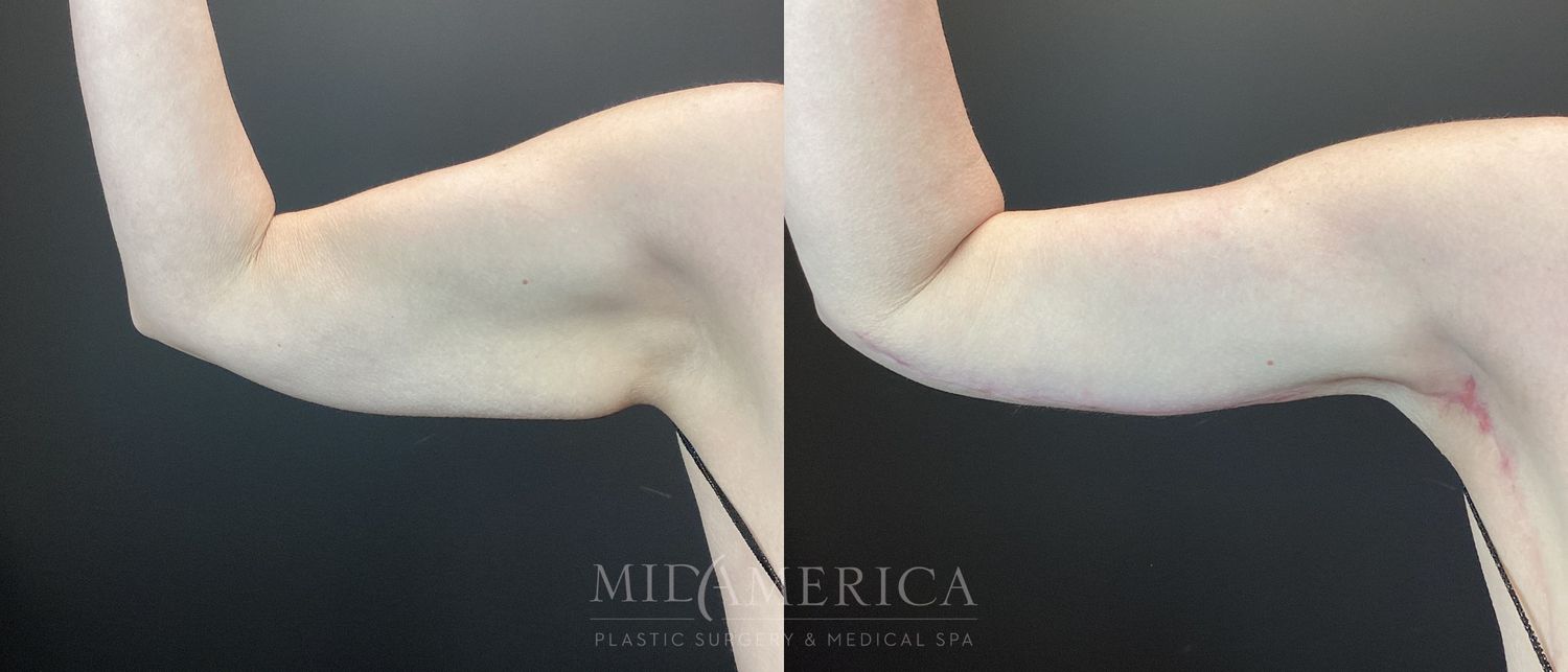 Brachioplasty Before & After