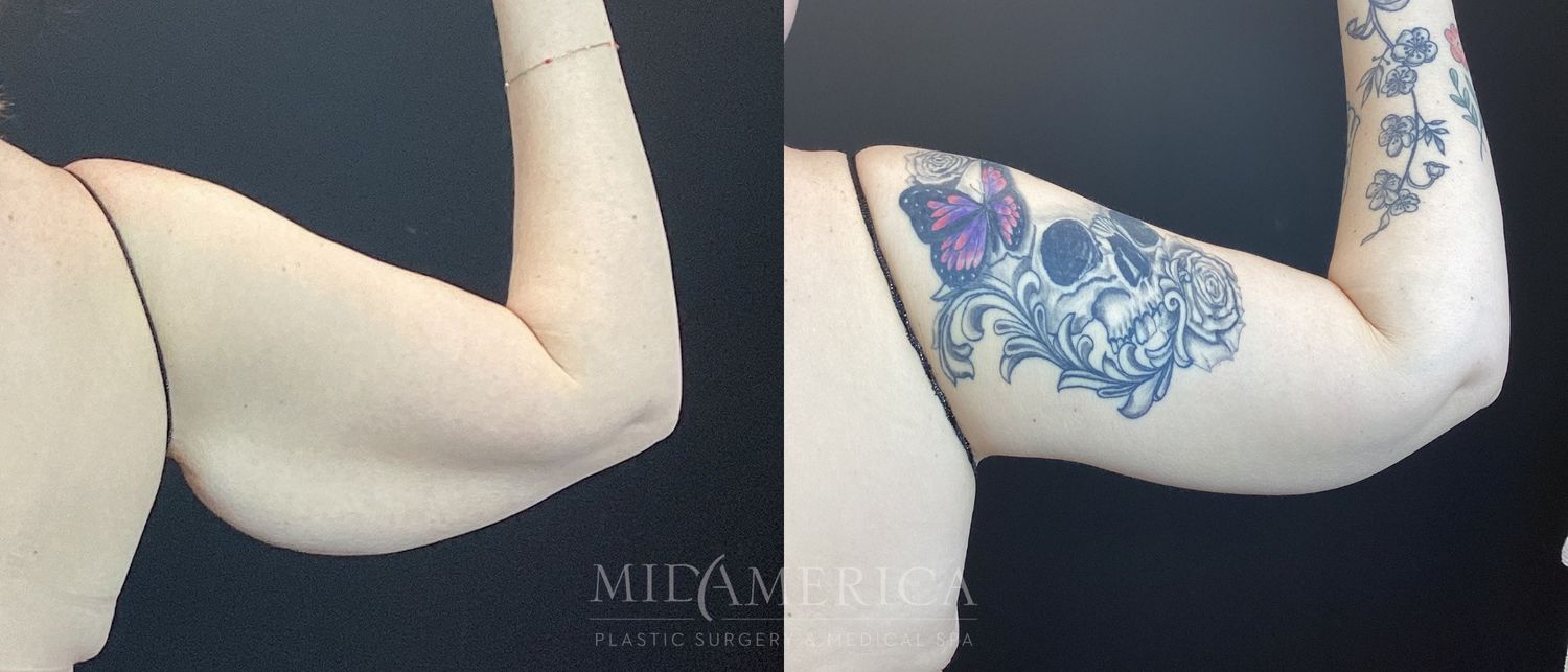 Brachioplasty Before & After
