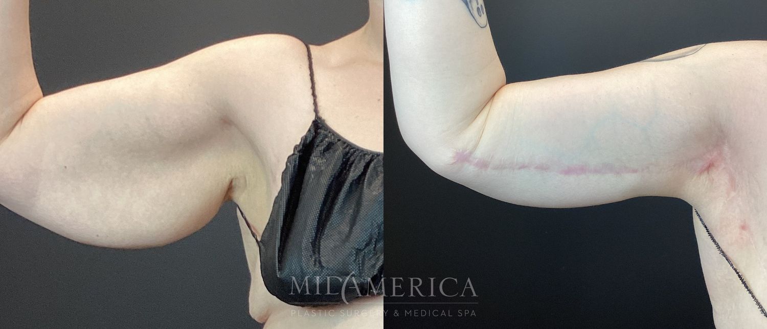 Brachioplasty Before & After